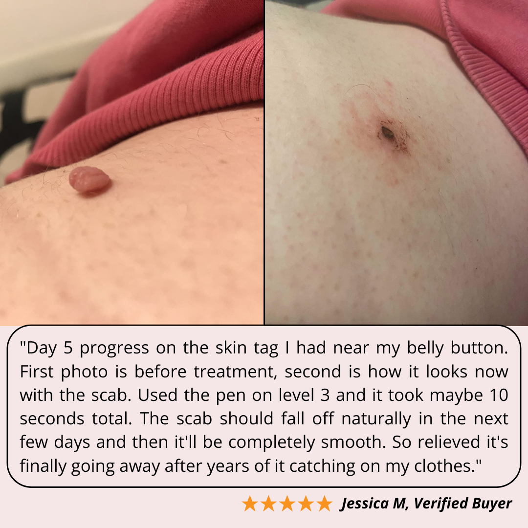 IonClear™ Plasma Carbon Arc Pen